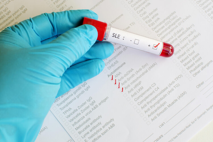 Lupus: What Do You Need to Know?